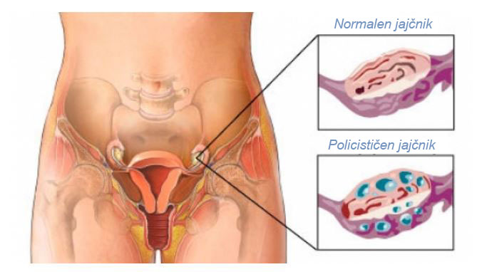 Primerjava zdravih in policističnih jajčnikov