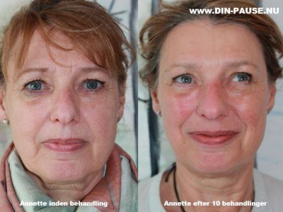 NARAVNO POMLAJEVANJE - JAPONSKI COSMO LIFTING.