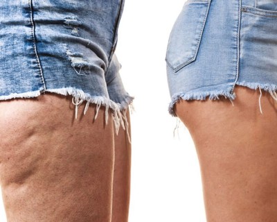 Louise Hay in TKM: kako se znebiti celulita?