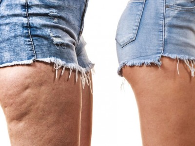 Louise Hay in TKM: kako se znebiti celulita?