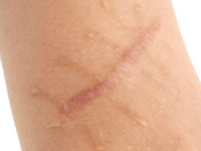  MSTR - tehnika sprostitve brazgotinastega tkiva